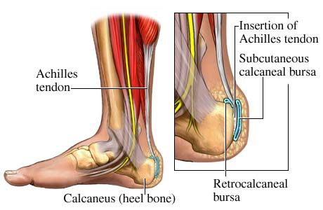 que causa el dolor en el tendon de aquiles