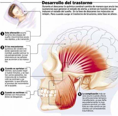 Bruxismo: 5 ejercicios para mejorar tu tensión en la mandíbula