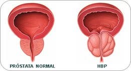 Los hombres y la fisioterapia uroginecológica: próstata, incontinencia y suelo pélvico