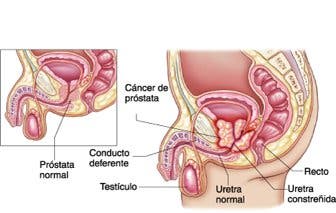 Los hombres y la fisioterapia uroginecológica: próstata, incontinencia y suelo pélvico