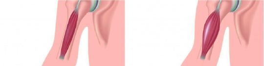 Distrofia muscular de Duchenne