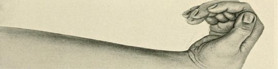 Síndrome de Volkmann