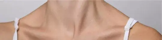 Fractura de clavícula
