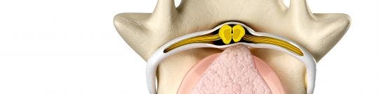 Hernia discal lumbar
