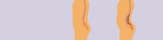 Hiperlordosis lumbar