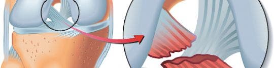 Rotura de ligamento lateral interno