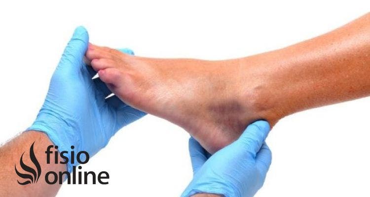 Fisioterapia y prevención en el pie diabético