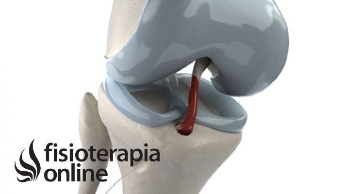 Ligamento cruzado anterior. Tratamiento de fisioterapia inicial y ejercicios en casa tras intervención quirúrgica.
