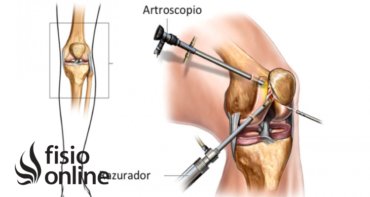 artroscopia