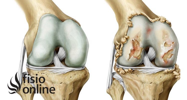 Artrosis de rodilla  Qué es, causas, síntomas y tratamiento