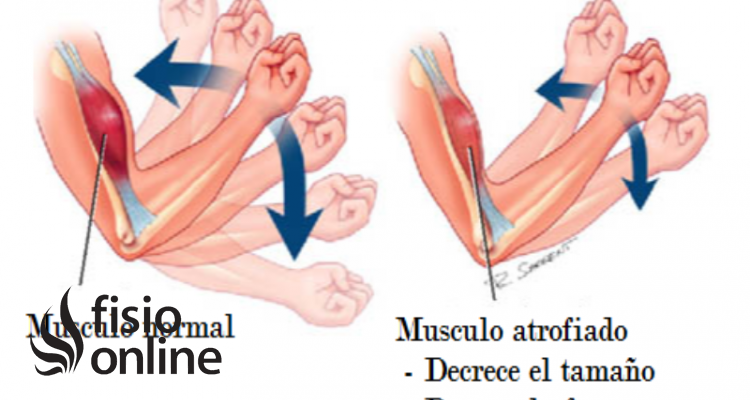 ATROFIA MUSCULAR