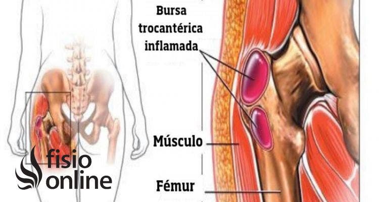 Bursitis