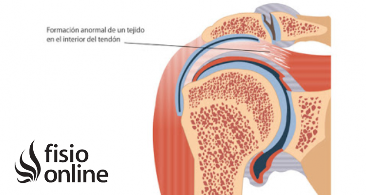 calcificación tendinosa