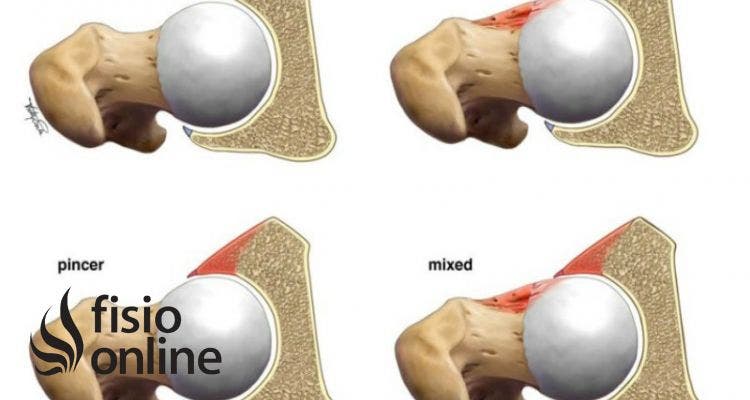 choque femoroacetabular