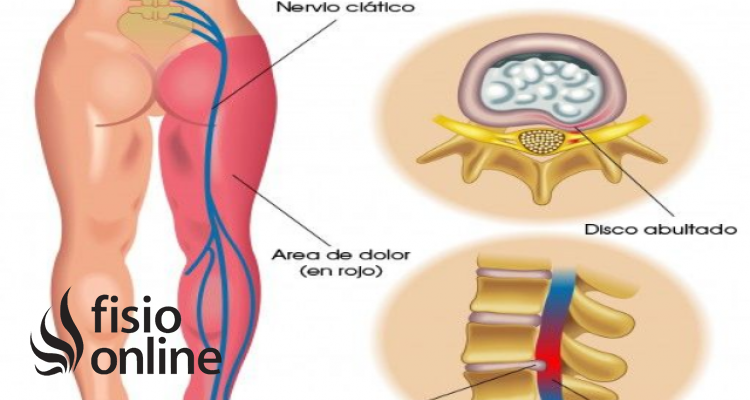 nervio ciático