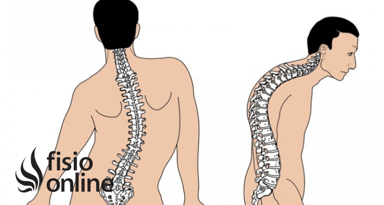 cifoescoliosis