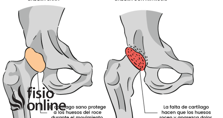 Dolor de cadera 