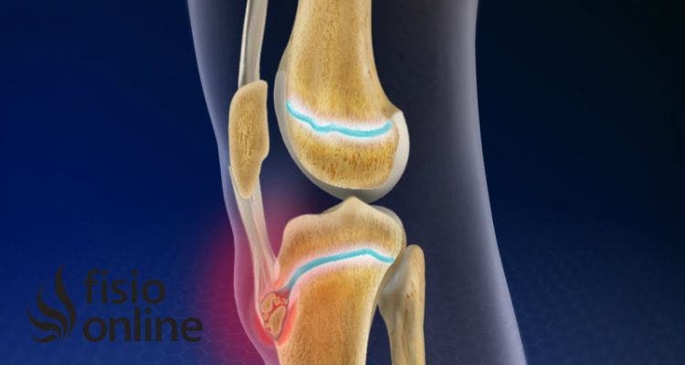 enfermedad de osgood schlatter