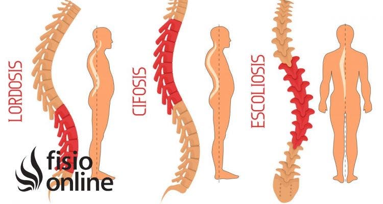 👨🏽‍⚕️ ¿Qué es la Escoliosis?