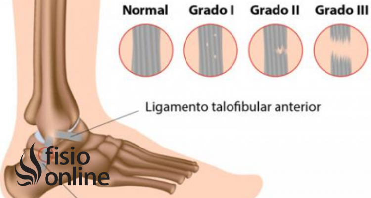 esguince grado tres