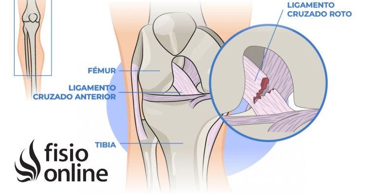 Esguince de rodilla 