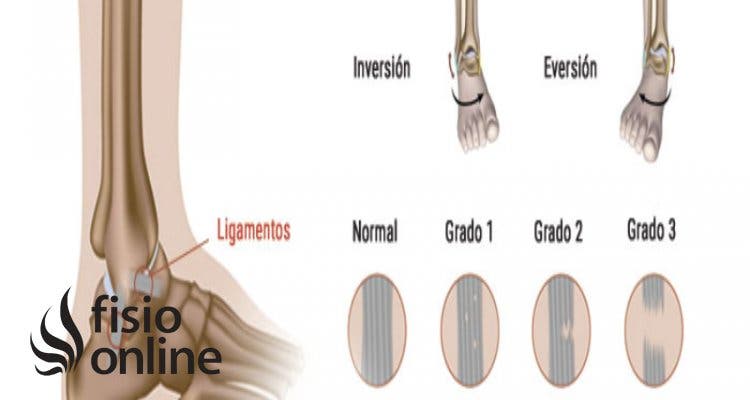 esguince de ligamentos