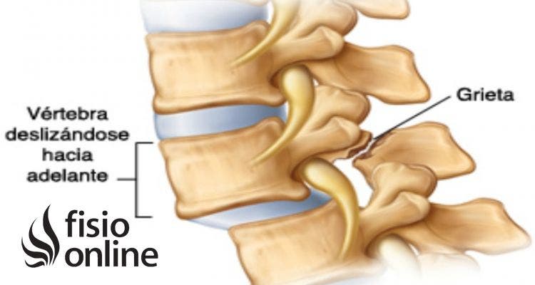 espondilolistesis