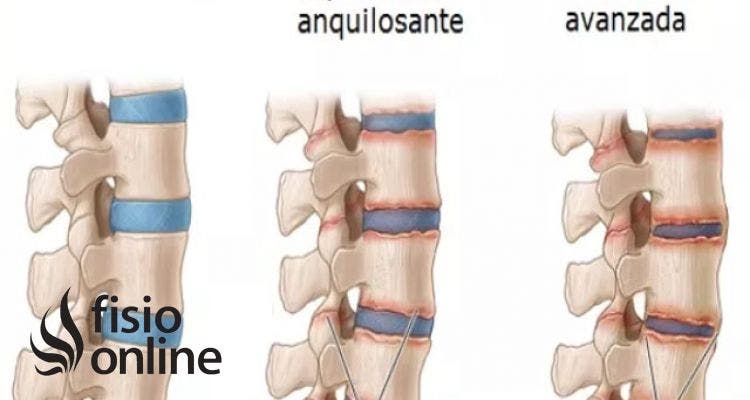 espondilitis anquilosante