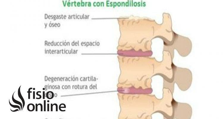 espondilosis