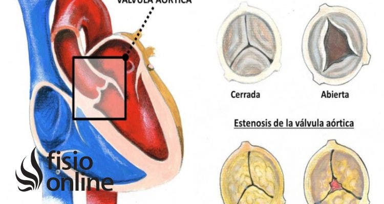 estenosis aortica