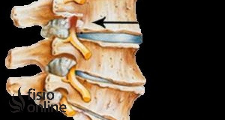 Estenosis del canal lumbar