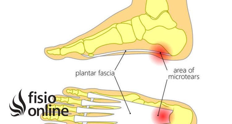 Fascitis plantar