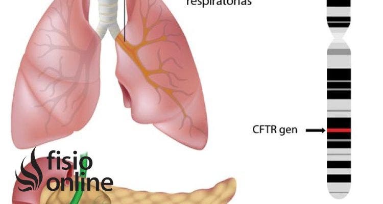 Fibrosis quistica