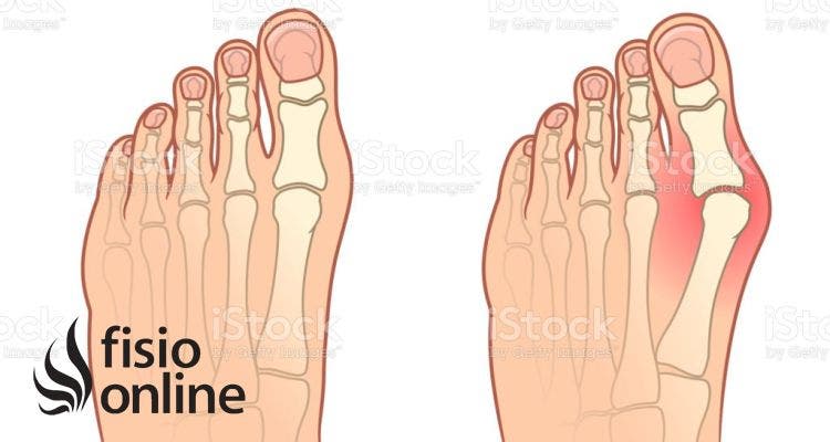 Hallux valgus