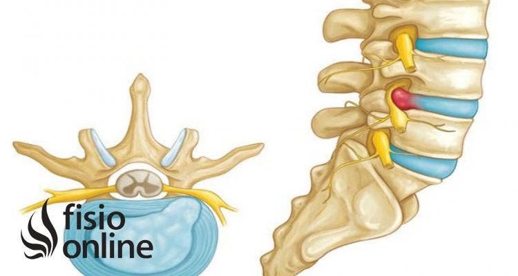 hernia discal