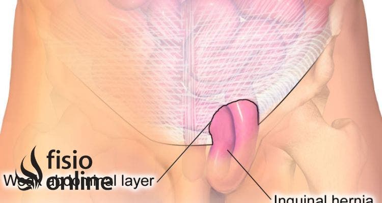 hernia inguinal