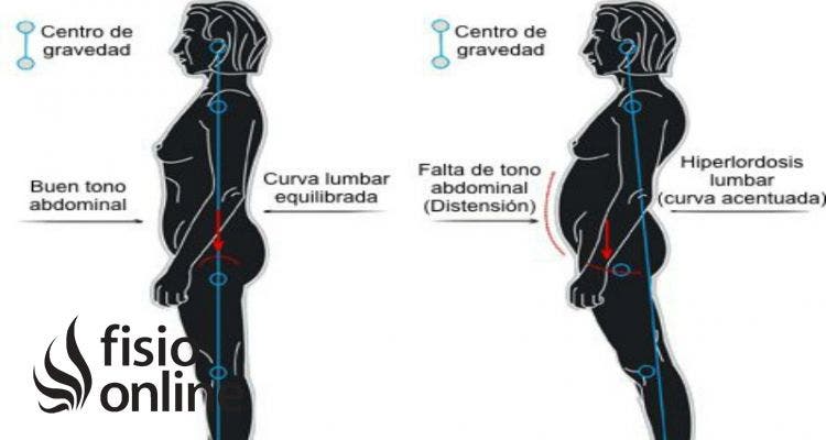 hiperlordosis