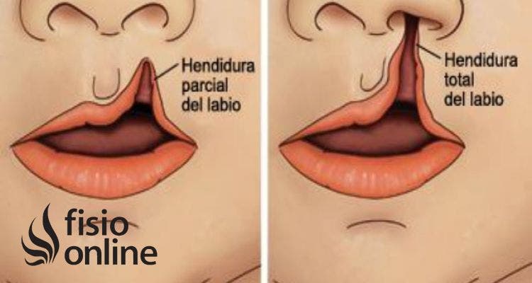 Labio leporino