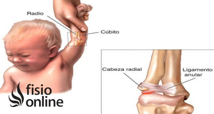 luxación de codo