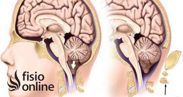 malformación de arnold chiari