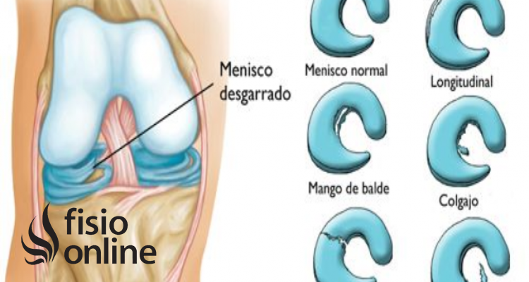 cuernos meniscales