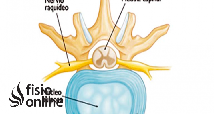 Nucleo pulposo y anillo fibroso discount