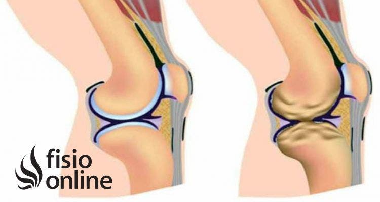 osteoartritis