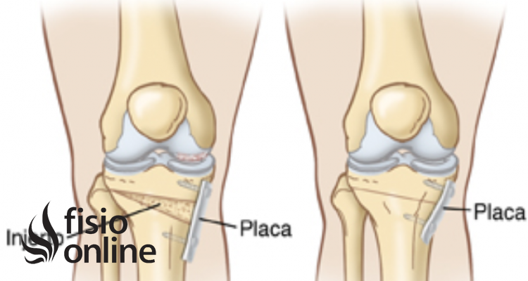 osteotomía