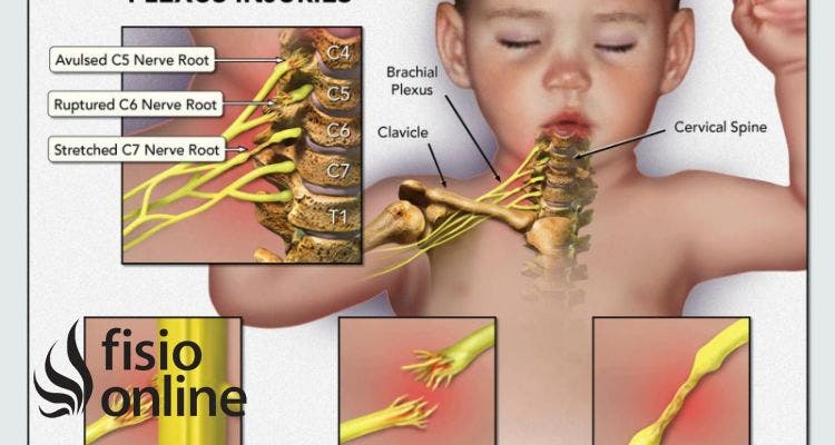parálisis braquial obstétrica