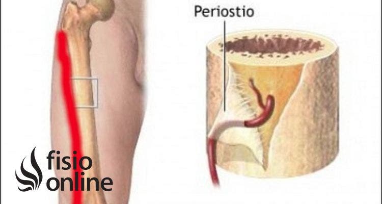 Periostitis tibial