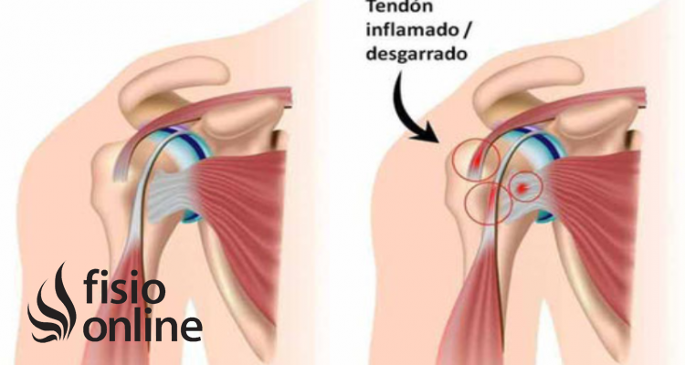 Pinzamiento articular