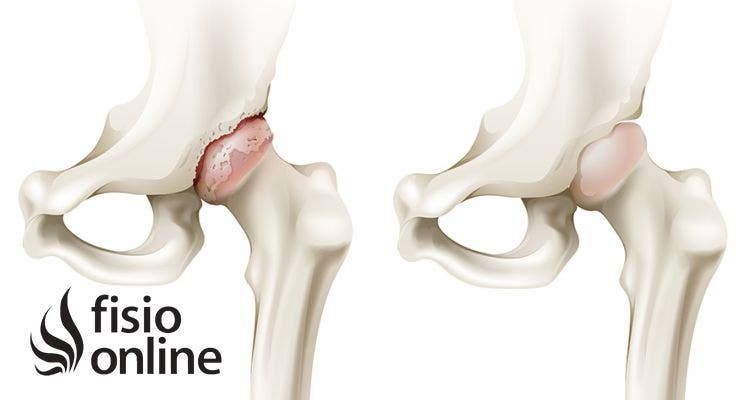 Pinzamiento femoroacetabular