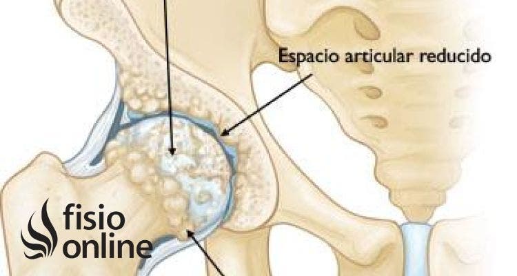 Protesis de cadera 