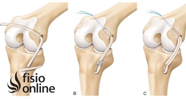 Rotura ligamento colateral interno 